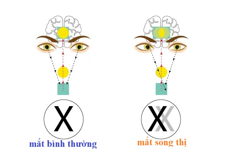 SONG THỊ LÀ GÌ? SONG THỊ CÓ TỰ KHỎI KHÔNG?